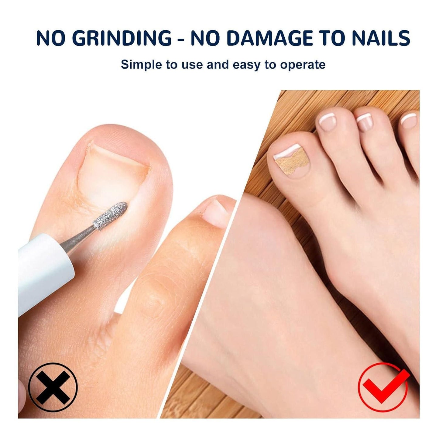 Ingrown Toenail Correction Stickers – Pain Relief & Nail Alignment (Pack of 1)