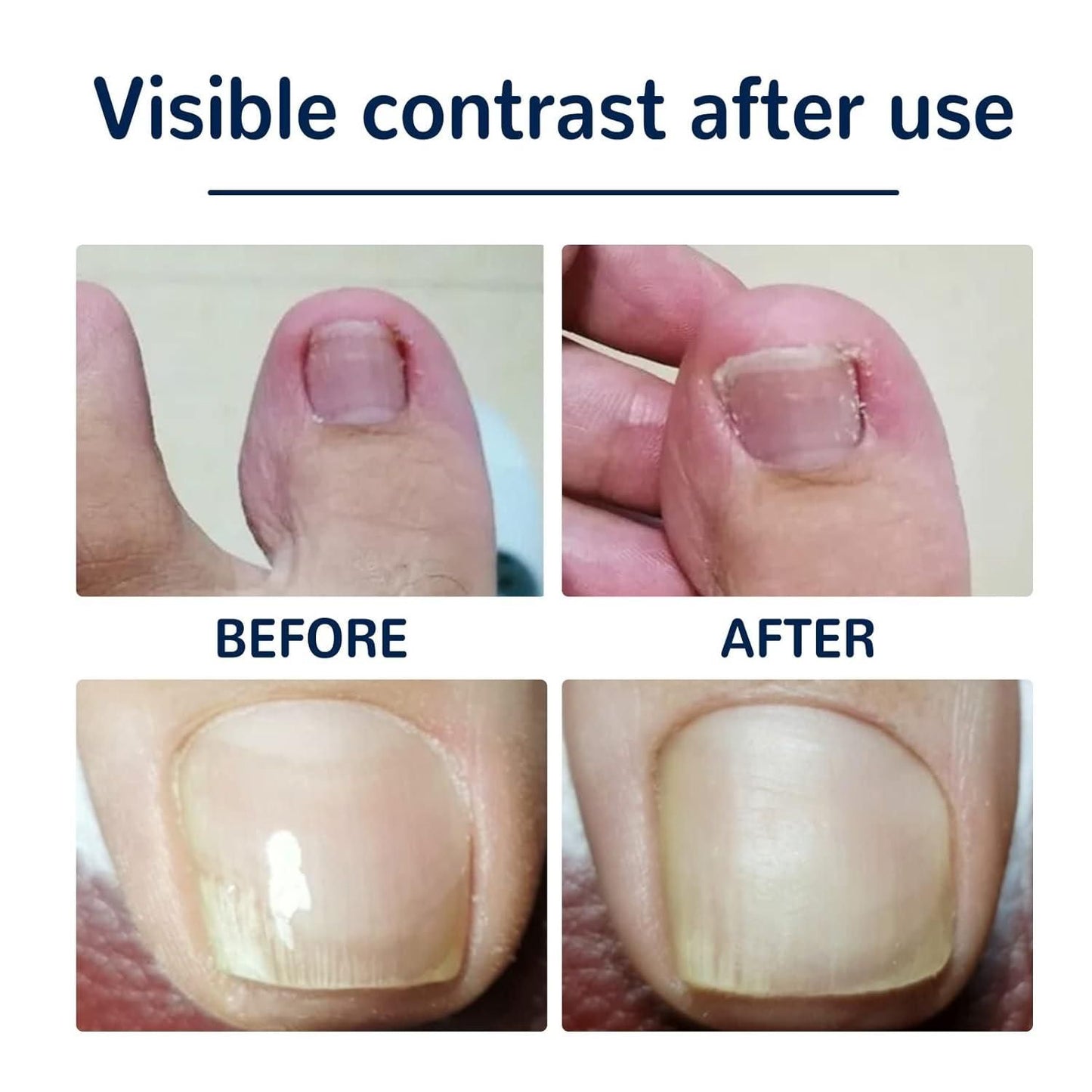 Ingrown Toenail Correction Stickers – Pain Relief & Nail Alignment (Pack of 1)