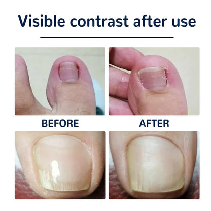 Ingrown Toenail Correction Stickers – Pain Relief & Nail Alignment (Pack of 1)